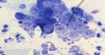 Chlamydia
